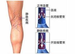 預(yù)防靜脈血栓 拒當(dāng)“久坐族”