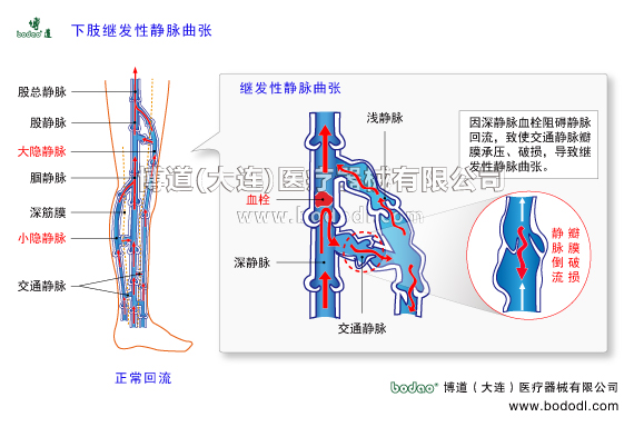 靜脈曲張的預(yù)防與治療