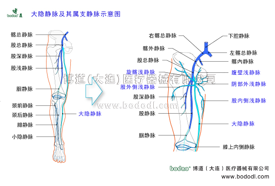 靜脈曲張的預(yù)防與治療