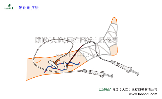 靜脈曲張的預(yù)防與治療