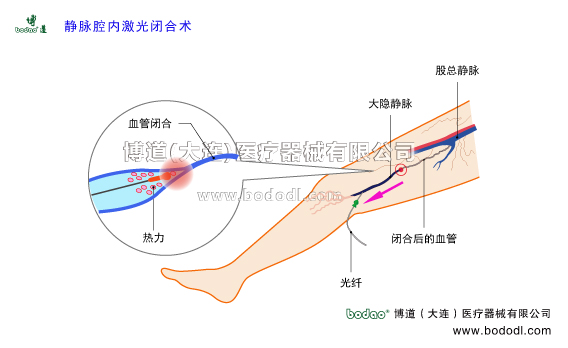 靜脈曲張的預(yù)防與治療