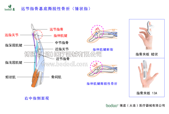 手關(guān)節(jié)常見傷病與健康防護(hù)