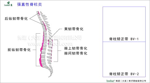 脊椎部疾病與健康護理