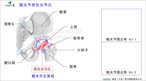 髖關(guān)節(jié)疾病與健康護理