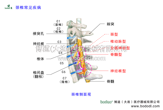 頸椎常見(jiàn)病頸椎病有幾種頸椎綜合癥的癥狀與治療頸型頸椎病神經(jīng)根型脊髓型頸椎病椎動(dòng)脈型交感神經(jīng)型頸椎病混合型頸椎病的病因與防護(hù)治療頸椎病的預(yù)防與治療頸椎構(gòu)造截面圖博道雙層可調(diào)式頸椎固定帶醫(yī)用矯正頸托護(hù)頸頸椎小關(guān)節(jié)不穩(wěn)頸椎骨質(zhì)增生因頸椎頸椎間盤肌肉筋膜韌帶等發(fā)生退行性改變長(zhǎng)期勞損不良姿勢(shì)外傷頸椎發(fā)育性椎管狹窄先天性畸形等因素導(dǎo)致頸椎失穩(wěn)椎間盤突出鉤椎關(guān)節(jié)突