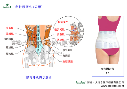 閃腰扭腰急性腰痛腰背筋膜損傷的主要癥狀與康復(fù)治療博道腰部固定帶醫(yī)用護(hù)腰急性腰扭傷易發(fā)部位，可分為豎脊肌損傷、多裂肌損傷、髂腰肌扭傷，棘上韌帶損傷，棘間韌帶損傷，胸腰深筋膜淺筋膜損傷，關(guān)節(jié)突關(guān)節(jié)損傷腰椎小關(guān)節(jié)損傷，腰骶關(guān)節(jié)損傷等。腰背部肌肉拉傷腰背部肌肉構(gòu)造腰大肌腰方肌豎脊肌多裂肌橫突間肌回旋肌腹外斜肌腹內(nèi)斜肌腹橫肌背闊肌胸腰筋膜腰椎間盤破裂腰椎骨裂骨折腰椎椎管狹窄腰椎小關(guān)節(jié)紊亂腰椎滑脫分離癥腰椎峽部