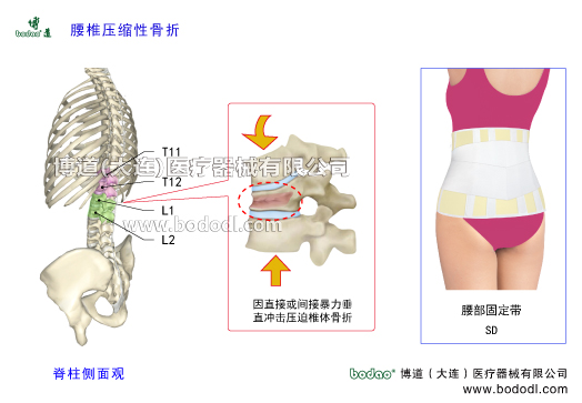 胸腰椎壓縮性骨折的發(fā)生原因、癥狀及治療。胸腰段壓縮性骨折的主要原因一是因間接暴力致傷及老年人骨質(zhì)疏松或肌肉瞬間強(qiáng)力收縮等所造成的創(chuàng)傷，二是因直接暴力致傷。另外，骨結(jié)核、骨腫瘤等疾病也可導(dǎo)致椎骨壓縮性骨折。博道腰椎固定帶透氣性醫(yī)用護(hù)腰的功能與防護(hù)作用。胸腰椎壓縮性骨折的易發(fā)部位及保守治療和手術(shù)治療方法。為什么胸腰段容易發(fā)生椎體壓縮性骨折。日本透氣性護(hù)腰帶腰椎部骨折支具，博道透氣性醫(yī)用腰部固定帶