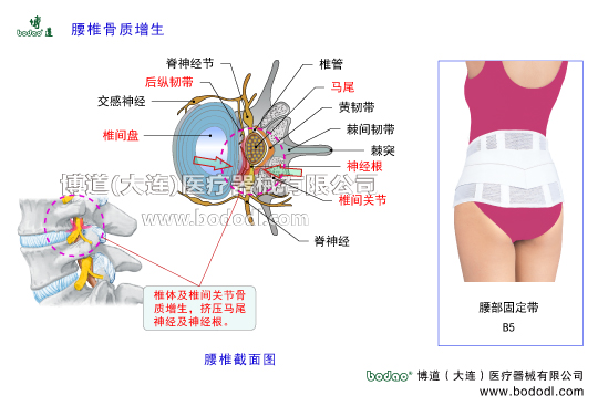 腰椎骨質(zhì)增生及其主要癥狀、腰椎增生的發(fā)病原因及治療與防護(hù)腰椎骨刺形成腰椎軟骨退行性病變及腰椎間盤膨出腰椎積累性損傷導(dǎo)致腰椎增生博道醫(yī)用護(hù)腰部固定帶的主要功能腰椎出血滲出鈣化唇樣骨質(zhì)增生骨橋椎間孔狹窄擠壓神經(jīng)根引發(fā)坐骨神經(jīng)炎，腰椎勞損神經(jīng)根交感神經(jīng)脊神經(jīng)節(jié)前縱韌帶后縱韌帶黃韌帶棘間韌帶棘上韌帶腰椎小關(guān)節(jié)囊椎間關(guān)節(jié)變形腰部軟組織勞損腰骶部慢性損傷腰椎部主要病癥閃腰急性筋膜損傷腰椎的構(gòu)造腰骶關(guān)節(jié)勞損馬尾神