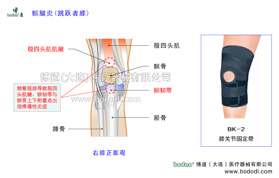 髕腱炎跳躍者，膝股四頭肌肌腱炎，博道髕腱加壓固定帶，透氣性膝關(guān)節(jié)加壓固定帶JK帶膝關(guān)節(jié)固定帶BK-2髕腱炎加壓護膝排行榜，臏腱炎跳躍者膝股四頭肌腱炎的病因與預(yù)防治療，肌腱炎加壓固定帶哪家好。膝關(guān)節(jié)常見疾病博道透氣護膝戶外運動矯形保暖護膝，股骨髕骨臏腱髕韌帶脛骨滑膜膝關(guān)節(jié)囊，膝關(guān)節(jié)矯正帶髕前韌帶髕下韌帶，髕韌帶長度及主要功能與作用，膝關(guān)節(jié)伸膝裝置與屈膝裝置。髕腱炎是長期勞損引起髕韌帶上下附著點出現(xiàn)疼痛