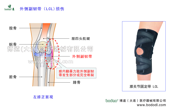 膝關(guān)節(jié)外側(cè)副韌帶損傷的原因、癥狀與康復(fù)治療。博道透氣性膝關(guān)節(jié)外側(cè)副韌帶LCL固定帶，膝關(guān)節(jié)損傷固定支具O型腿矯正固定X型腿矯正固定膝關(guān)節(jié)骨質(zhì)增生內(nèi)側(cè)半月板損傷斷裂矯正康復(fù)固定，外側(cè)半月板損傷斷裂矯正與康復(fù)固定膝關(guān)節(jié)外傷護膝支架支具哪家好。膝關(guān)節(jié)加壓固定帶排行榜博道LCL加壓護膝關(guān)節(jié)外側(cè)副韌帶損傷固定帶膝關(guān)節(jié)LCL損傷的預(yù)防與治療膝關(guān)節(jié)外側(cè)副韌帶損傷可調(diào)節(jié)式固定夾板LCL外側(cè)副韌帶重建固定支架