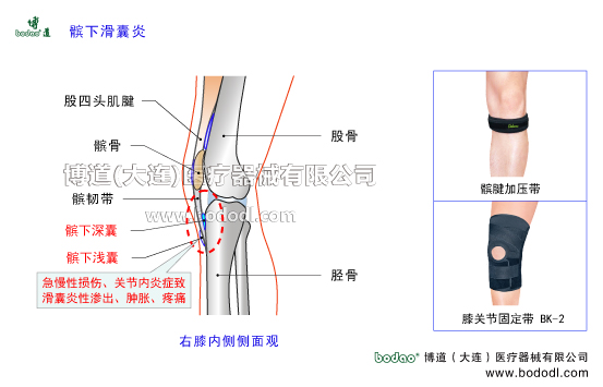 髕下滑囊炎膝關(guān)節(jié)髕下滑囊炎的病因癥狀與防護治療方法。髕下深囊脛骨粗隆腱下囊髕下滑囊炎的防護與治療。髕下滑囊的構(gòu)造與功能。髕下淺囊皮下囊及脛骨粗隆皮下囊。股四頭肌腱。膝關(guān)節(jié)髕下滑囊炎的癥狀與博道膝關(guān)節(jié)固定帶的防護功能，髕腱加壓帶JK帶可調(diào)式膝關(guān)節(jié)卡盤固定支架透氣性醫(yī)用護膝，下肢腿部術(shù)后固定夾板日本護膝腿部骨折固定夾板。醫(yī)用加壓護膝BK-2具有減輕膝關(guān)節(jié)壓力和摩擦、增加襯墊和滑動、保護髕韌帶與脛骨免于相