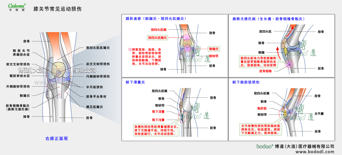 膝關(guān)節(jié)運(yùn)動(dòng)損傷的類型與癥狀