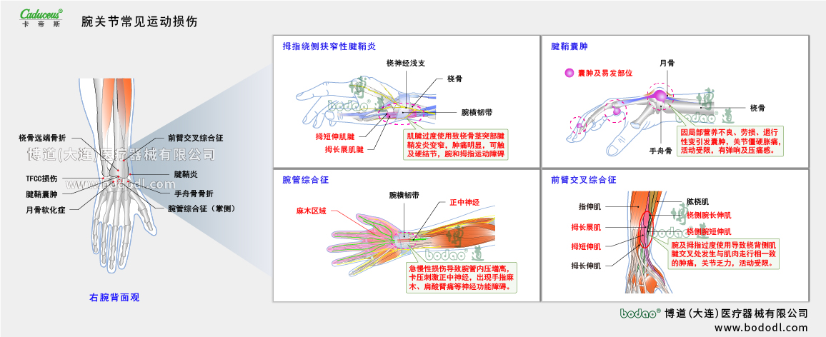 腕關(guān)節(jié)運動損傷的類型與癥狀