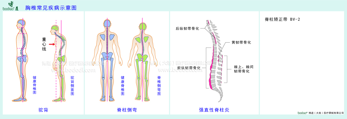 胸椎常見疾病示意圖