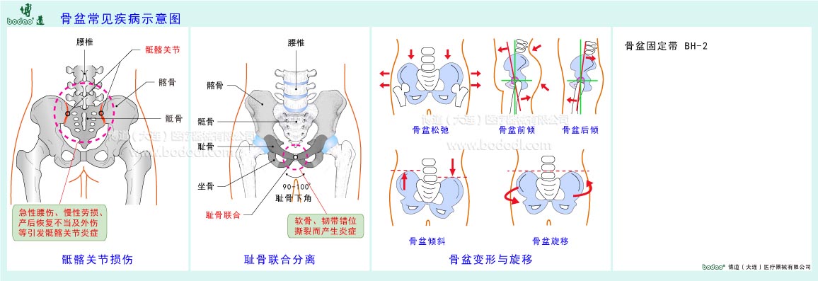 骨盆常見疾病示意圖