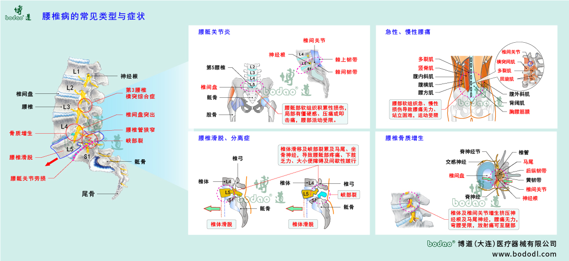 腰椎病的類型與癥狀