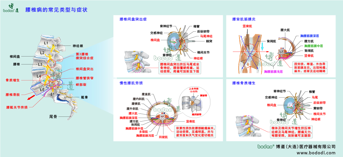 腰椎病的類型與癥狀