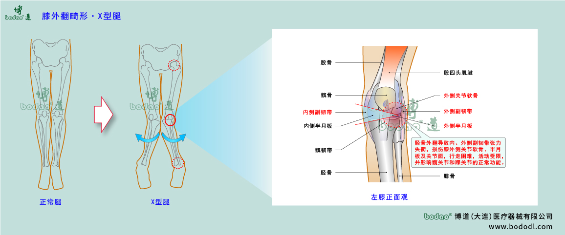 膝關(guān)節(jié)疾病的類型與癥狀