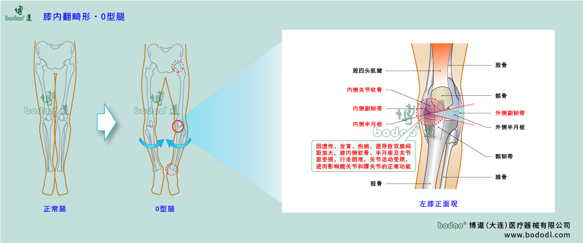 膝關(guān)節(jié)疾病的類型與癥狀