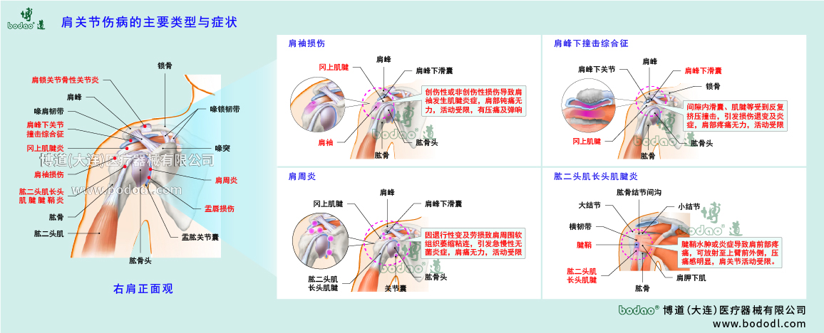 肩關(guān)節(jié)傷病的類型與癥狀