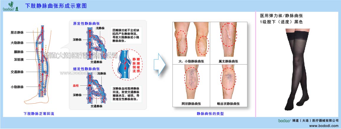 下肢靜脈曲張與健康防護(hù)