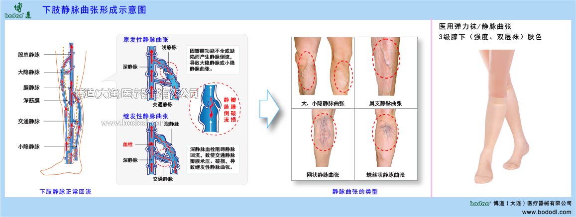 下肢靜脈曲張與健康防護(hù)