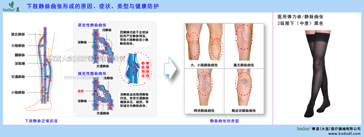 下肢靜脈曲張與健康防護(hù)