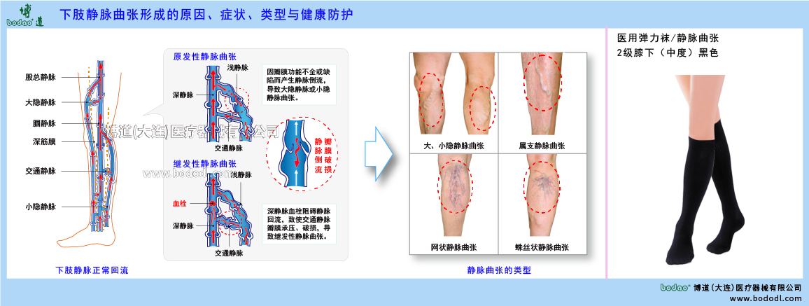 下肢靜脈曲張與健康防護(hù)