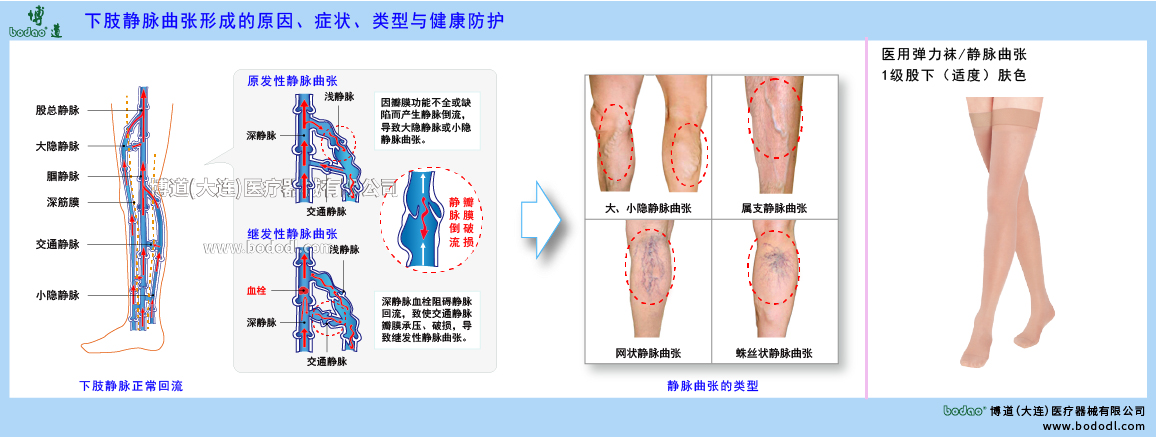 下肢靜脈曲張與健康防護(hù)